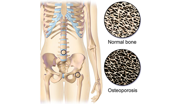 Osteoporosis Treatment In Gwalior