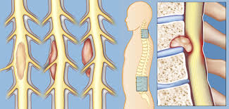 Spine Tumor Treatment In Gwalior​