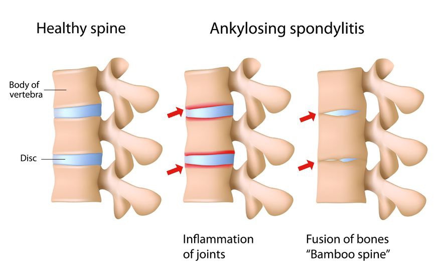 spine arthritis treatment in gwalior