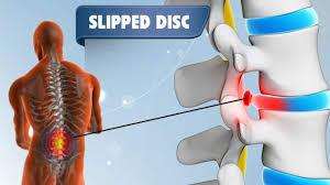 Slip Disk Treatment In Gwalior