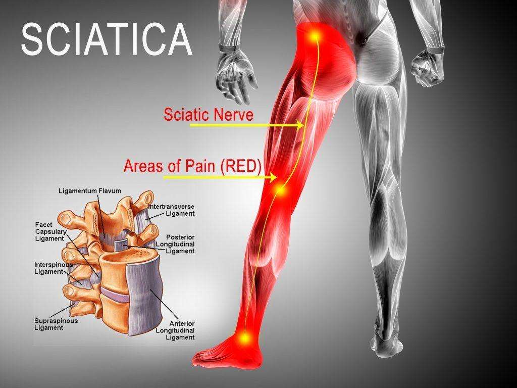 Sciatica Treatment In Gwalior