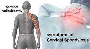 Cervical Osteoarthritis Symptoms
