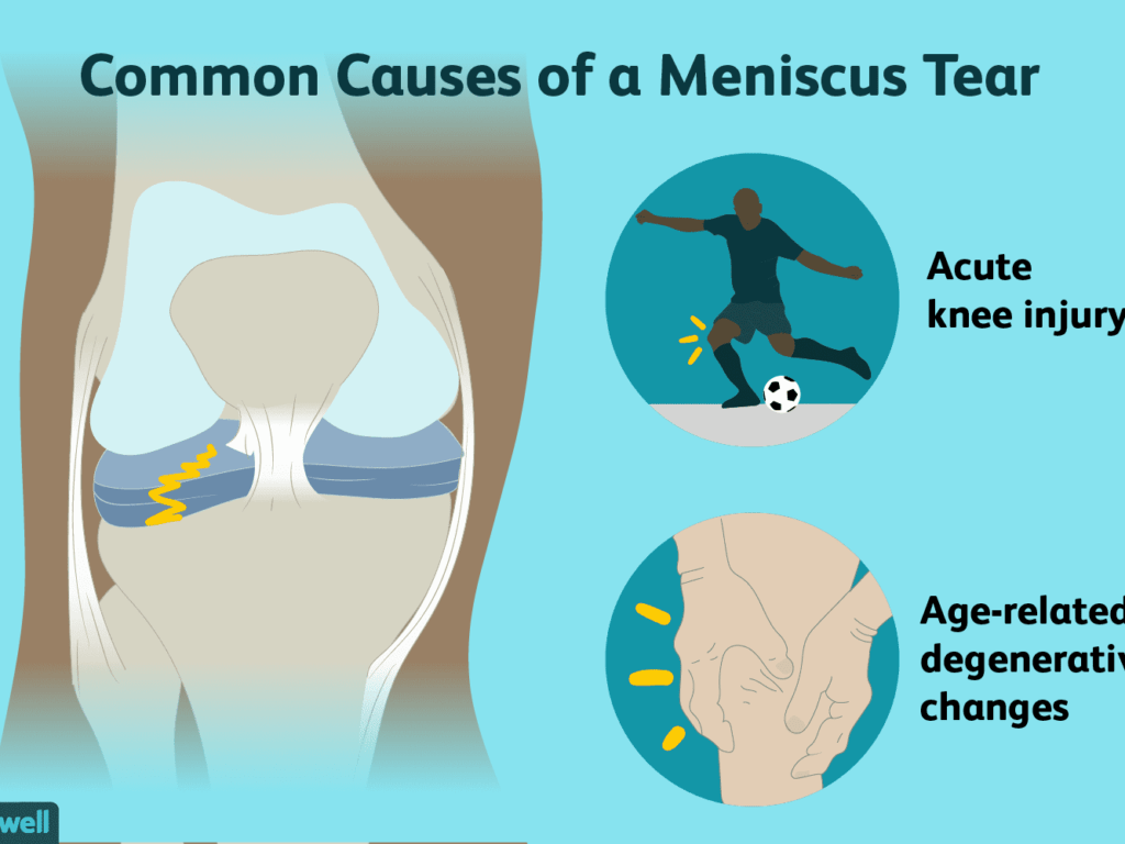 MENISCUS TEAR