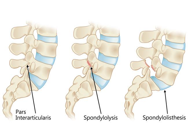 Spondylolisthesis vs Spondylolysis