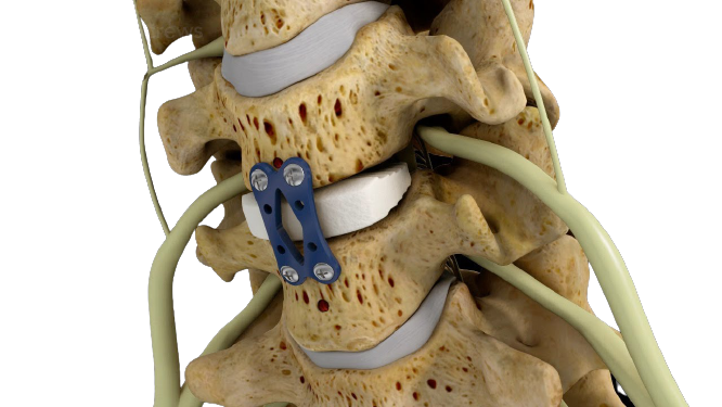 Anterior Cervical Discectomy Fusion Acdf In Gwalior