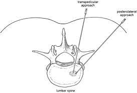 percutaneous spinal biopsy in gwalior