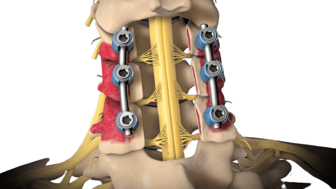 POSTERIOR CERVICAL LAMINECTOMY OR LAMINOPLASTY WITH LMS IN GWALIOR.