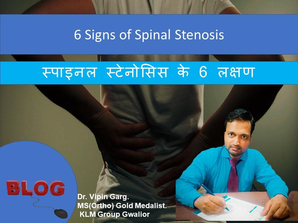6 Signs of Spinal Stenosis