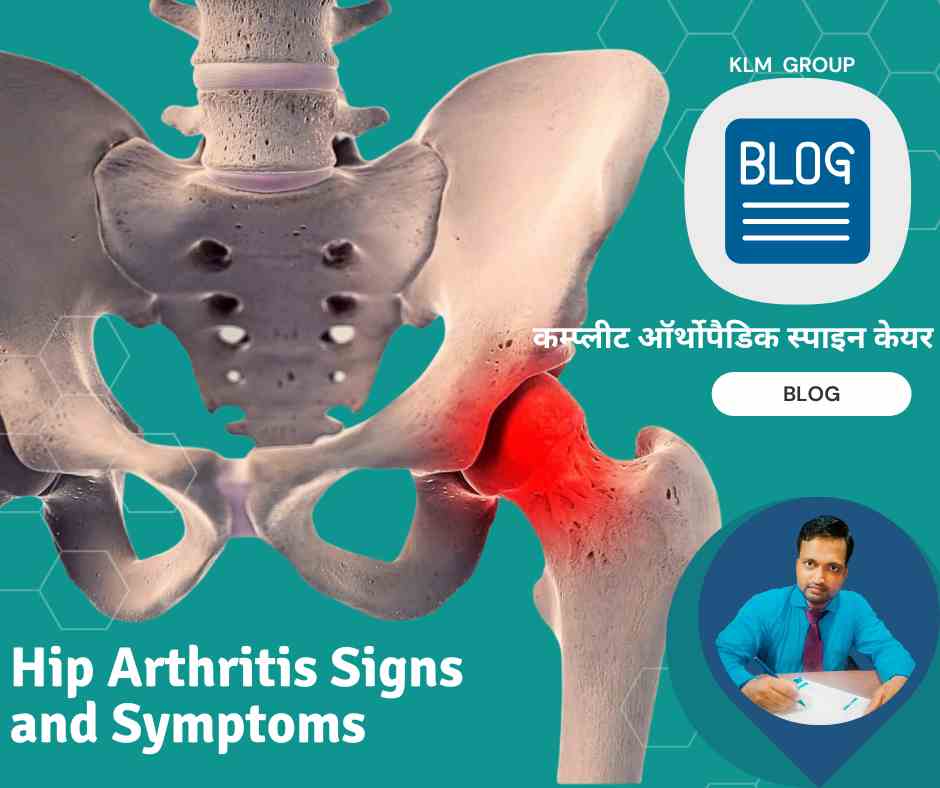 Hip Arthritis Signs and Symptoms