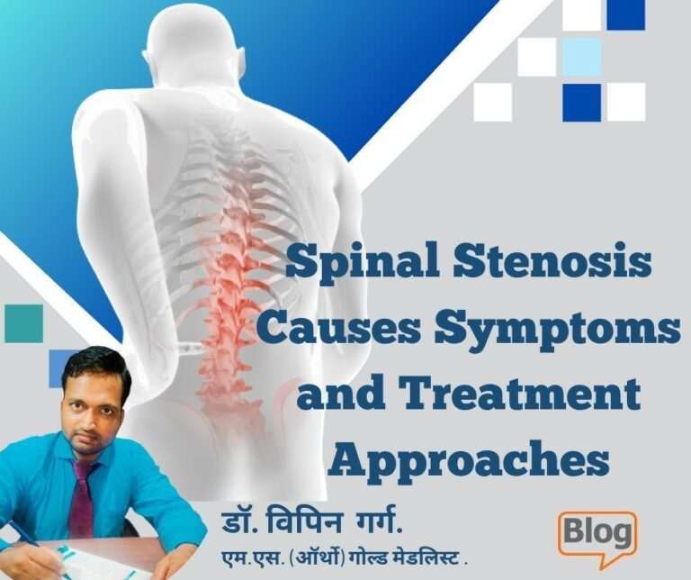 Great Knowledge | Spinal Stenosis Causes Symptoms And Treatment ...